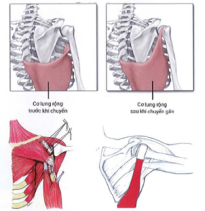 ảnh minh họa: Chuyển cơ lưng rộng Nguồn: Lennard Funk (2012), J Shoulder Elbow Surg