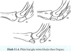 Phân loại theo Duparc (1990):