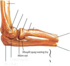 Gãy mỏm khuỷu là gãy xương phạm khớp.