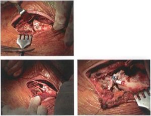 Trật khớp ức đòn: Hình ảnh trong mổ kỹ thuật tái tạo sử dụng gân tự thân