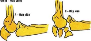 Phân loại gãy mỏm khuỷu theo Mayo (2006)