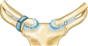 Trật khớp ức đòn: Cố định xương đòn vào xương sườn 1