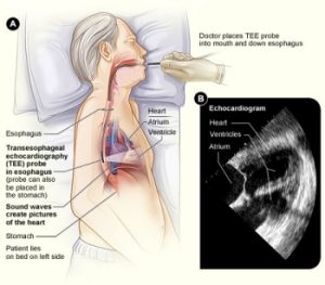 Siêu âm tim qua thực quản