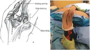 Gãy mỏm khuỷu đường mổ