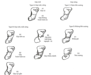 16.12 Phân loại gãy xương thuyền theo Herbet