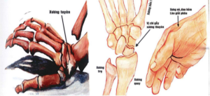 16.2 Tổn thương đặc trưng trong gãy xương thuyền