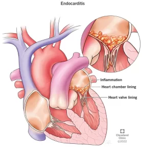 Viêm nội tâm mạc nhiễm khuẩn