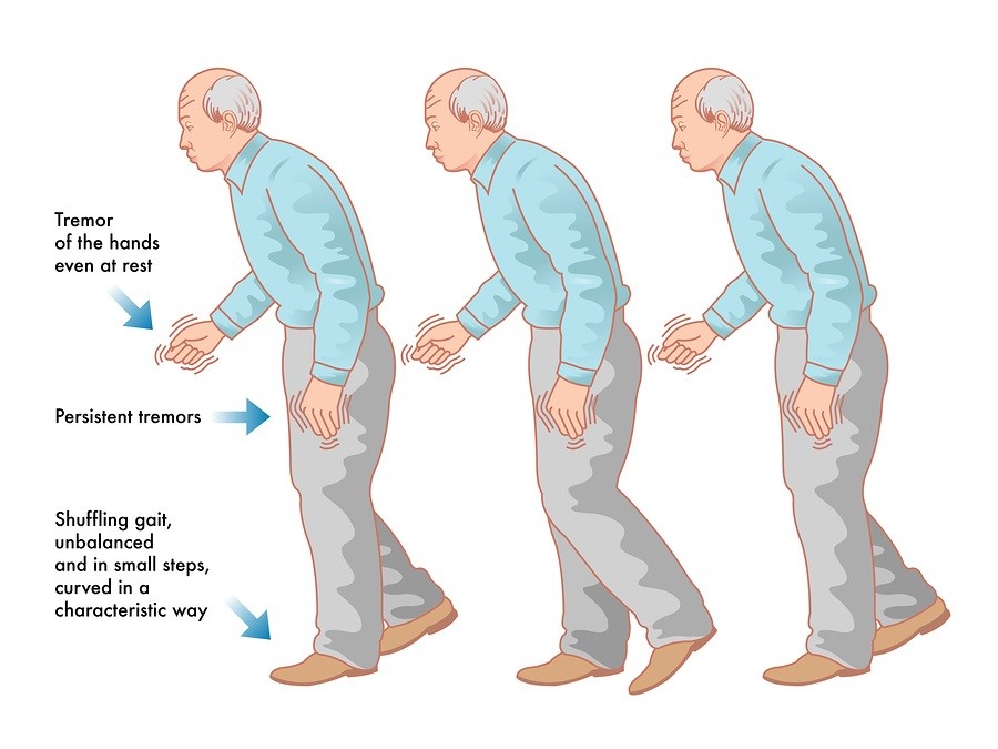 Biến chứng vận động và chất lượng cuộc sống ở bệnh nhân Parkinsons giai đoạn 3 và 4 theo Hoehn và Yahr