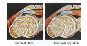 Ảnh minh họa: rách mặt khớp