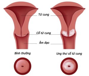 minh-hoa-ung-thu-co-tu-cung