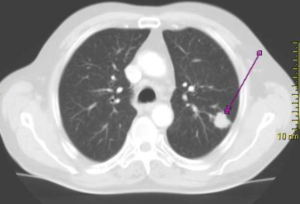 Chụp CT- Scanner có thể phát hiện ung thư phổi