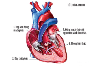 benh-hoc-tu-chung-fallot