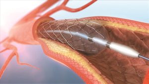 stent mạch vành trong can thiệp động mạch vành qua da