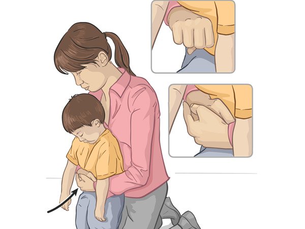 Kĩ thuật Heimlich ở trẻ em