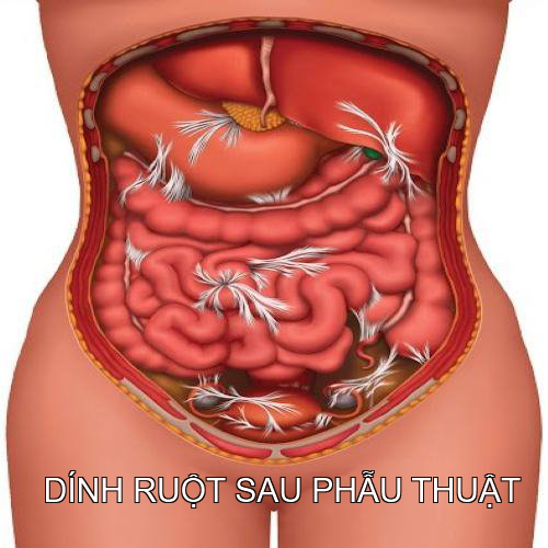 Cách phòng tránh dính ruột sau phẫu thuật