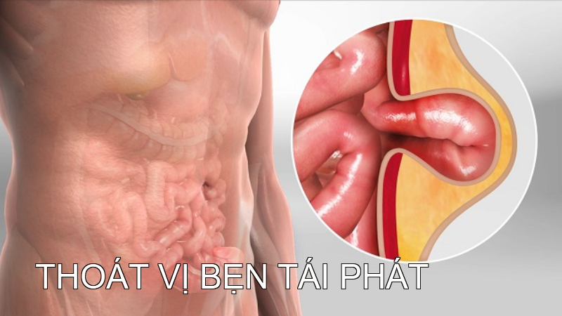 Thoát vị bẹn tái phát: yếu tố gây tái phát và cách điều trị