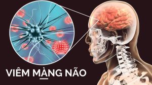 Bệnh viêm màng não nhiễm khuẩn