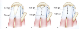 ảnh minh họa: Rách hình chữ u và kỹ thuật khâu lại Nguồn: AANA Advanced Arthroscopy (2010), The Shoulder