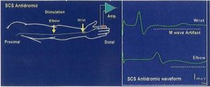 Điện sinh lý: Sơ đồ ghi điện thế cảm giác dây thần kinh giữa ngược chiều