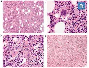 da-hong-cau-nguyen-phat-polycythemia-vera