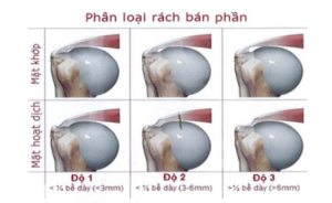 Ảnh minh họa: Phân loại rách bủn phấn