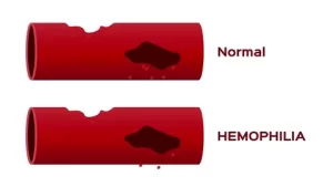 Hemophilia