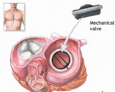 Tổng quan phẫu thuật thay van động mạch chủ