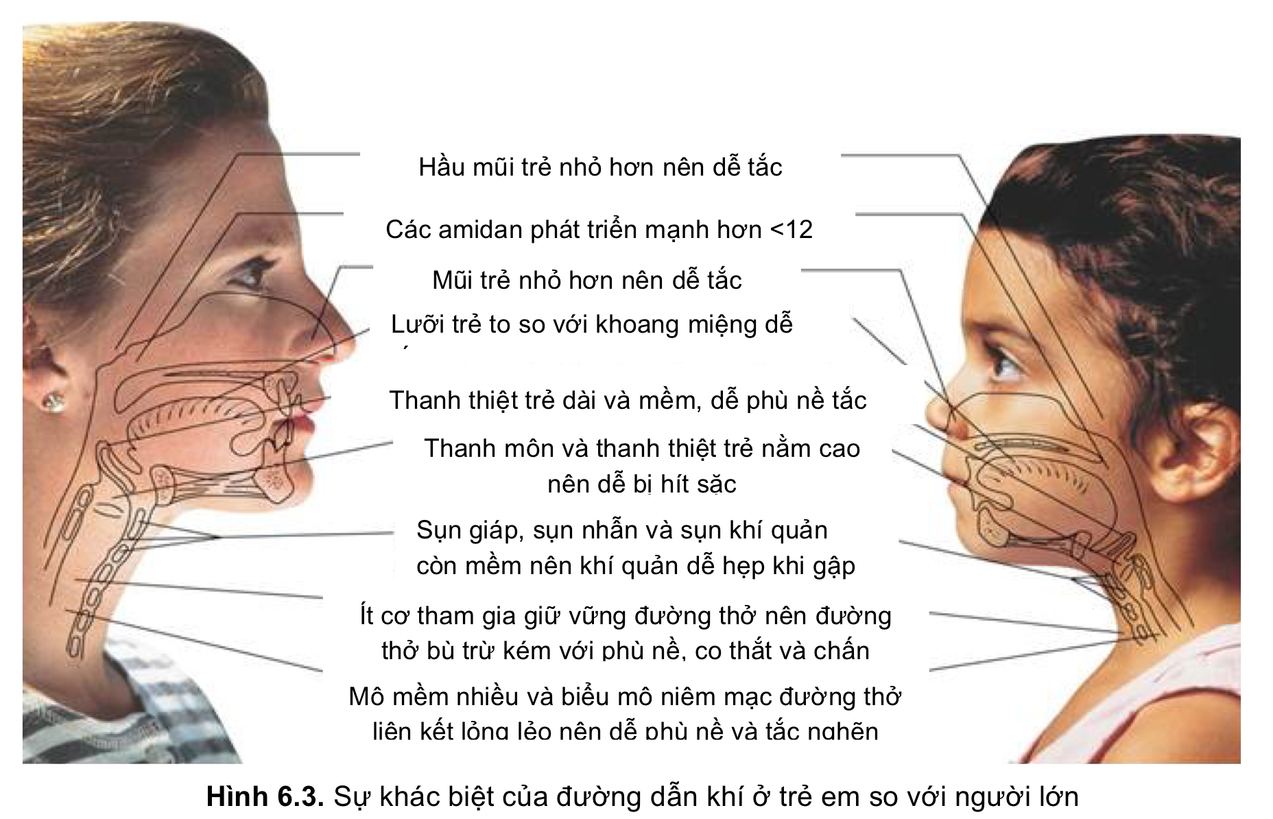 Sự khác biệt của đường dẫn khí ở trẻ em so với người lớn