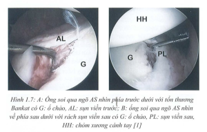 Phẫu thuật nội soi