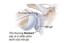 Tổn thương Bankari