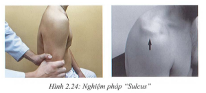 Nghiệm pháp kéo giãn (Slucus Test)