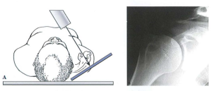 Minh hoạ tư thế chụp X quang trước - sau (anteroposterior: AP)