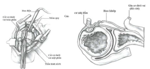 Hình ảnh minh họa phẫu tích cắt điểm bám cơ dưới vai 