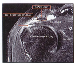 Hình ảnh chồi xương, dịch trong khoang dưới mỏm cùng vàrách chóp xoay 