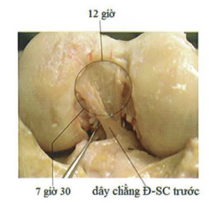 Giải phẫu diện bám đùi của DCCS theo mặt đổng hồ