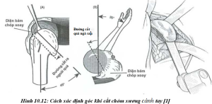  thay khớp vai toàn 