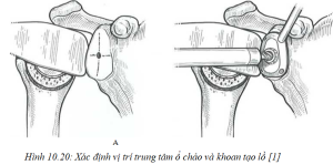  thay khớp vai toàn 