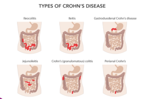 Minh-hoa-trieu-chung-benh-Crohn