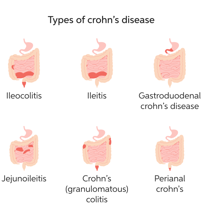 Minh-hoa-danh-gia-vi-tri-benh-Crohn