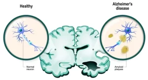 Bệnh Alzheimer