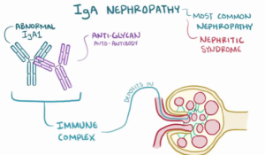 Bệnh thận IgA