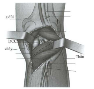 Bộc lộ diện bám chày của DCCS bằng đường rạch da hình chừ Z, vén đầu trong cơ bụng chân ra ngoài