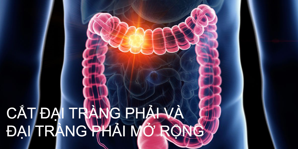 Quy trình phẫu thuật nội soi cắt đại tràng trong điều trị ung thư