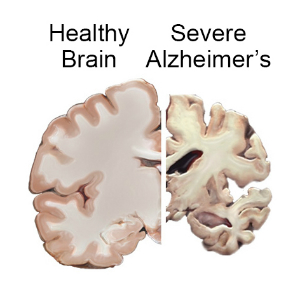 Bệnh Alzheimer