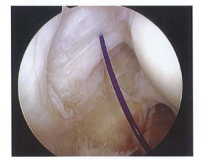 ảnh minh họa: Đánh dấu vị trí rách bang chi lì ị lon Nguôn: AANA Advanced Arthroscopy (2010), The Shoulder