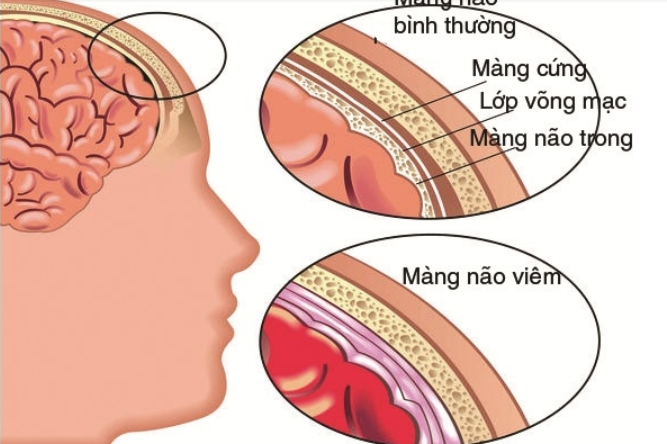 Giải phẫu bệnh viêm màng não mủ