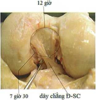 Giải phẫu diện bám đùi của DCCS theo mặt đồng hồ