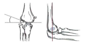 Góc baumann và bờ trước xương cánh tay đi qua chỏm con