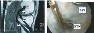 Hình ảnh đường hầm chày của BTN và BST trên cộng hưởng từ (A) và trên nội soi khớp (B)