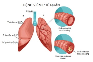 hinh-anh-viem-phe-quan